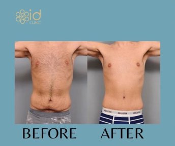 Before and after male tummy tuck results at ID Clinic Bangkok, improved abdominal contour