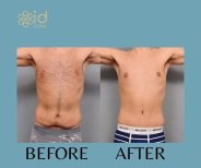 Before and after male tummy tuck results at ID Clinic Bangkok, improved abdominal contour