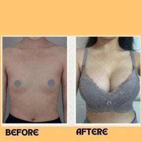 Before and after breast augmentation with silicone implants at ID Clinic Bangkok, visible results
