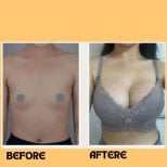Before and after breast augmentation with silicone implants at ID Clinic Bangkok, visible results
