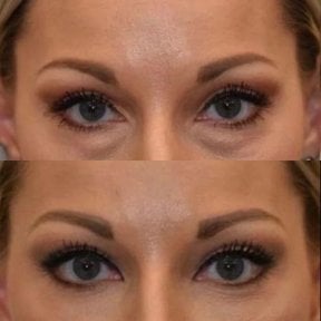 Blepharoplastik Vorher-Nachher-Ergebnis bei Dr. Safa Manav Clinic, Lidkorrektur
