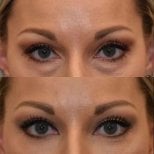 Blepharoplastik Vorher-Nachher-Ergebnis bei Dr. Safa Manav Clinic, Lidkorrektur