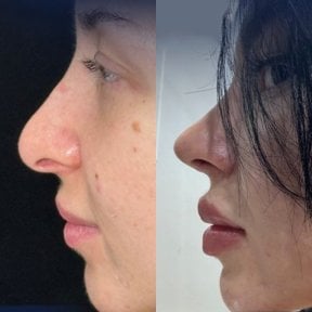 Resultados de rinoplastia antes y después en Dr. Safa Manav Clinic, mejora de la nariz