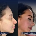 Resultados de rinoplastia antes y después en Dr. Safa Manav Clinic, mejora del perfil nasal