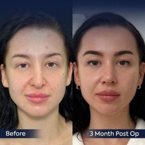 Resultados de rinoplastia antes y después en Dr. Safa Manav Clinic, 3 meses tras cirugía