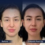 Resultados de rinoplastia antes y después en Dr. Safa Manav Clinic, 3 meses tras cirugía