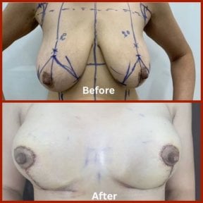Before and after breast lift results at DGB Clinic, improved breast shape and contour