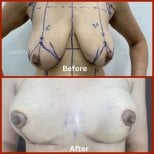 Before and after breast lift results at DGB Clinic, improved breast shape and contour