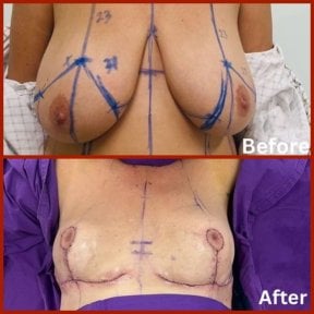 Before and after breast lift results at DGB Clinic, visible breast contour improvement