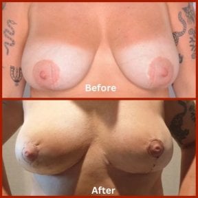 Before and after breast lift results at DGB Clinic, improved breast shape and contour