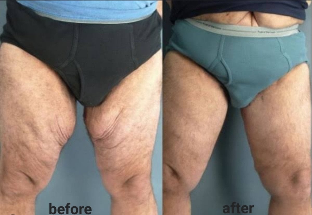 До і після фул баді ліфтингу в ID Clinic Bangkok, покращений контур стегон і підтяжка шкіри