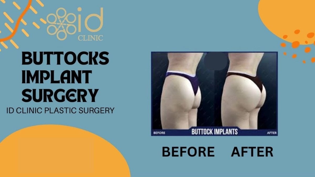 Результати до і після імплантації сідниць в ID Clinic Bangkok, покращений контур