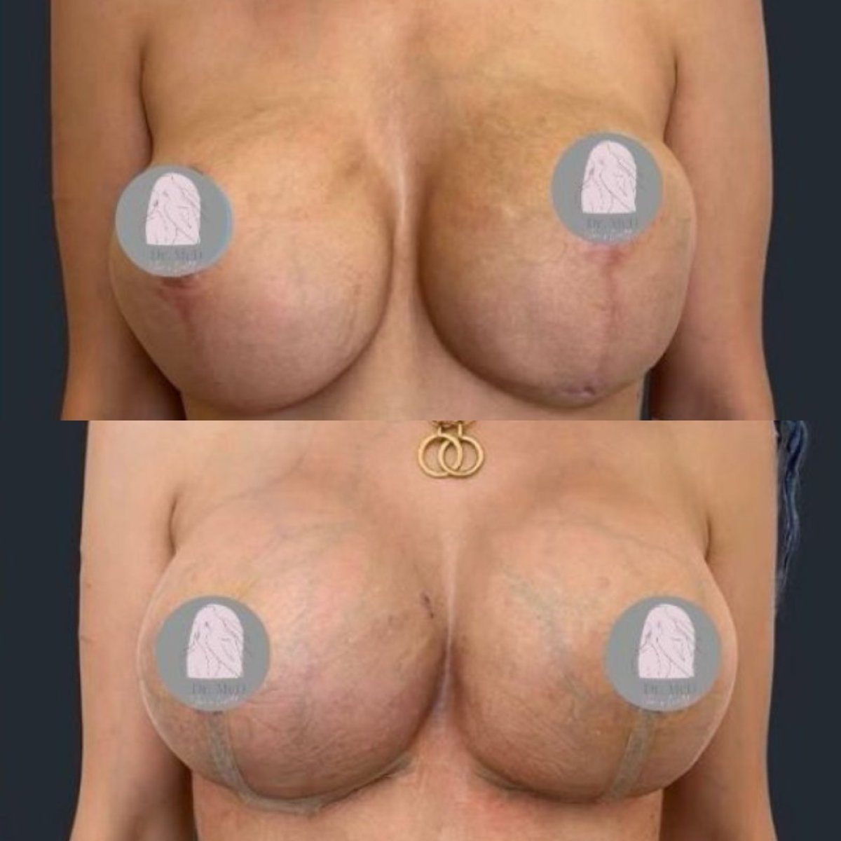 Efekty przed i po powiększaniu piersi w klinice Dr. MED, poprawiony kształt biustu