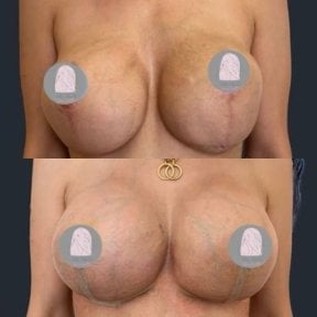 Vorher-nachher-Ergebnisse Brustvergrößerung bei Dr. MED, verbesserte Brustform