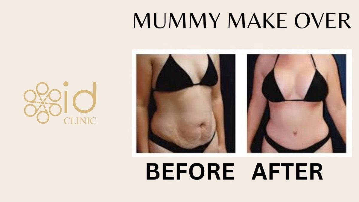 Before and after tummy tuck results at ID Clinic Bangkok, visible abdominal contour improvement
