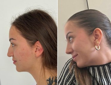 Vorher-nachher-Rhinoplastik-Ergebnis bei Dr. Safa Manav Clinic, verbesserte Nasenprofil