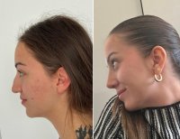 Vorher-nachher-Rhinoplastik-Ergebnis bei Dr. Safa Manav Clinic, verbesserte Nasenprofil