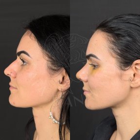 Vorher-nachher-Ergebnisse der Nasenkorrektur bei Dr. Safa Manav Clinic, Nasenformung Frau