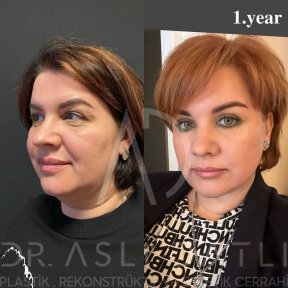 Vorher-nachher-Ergebnis Deep Plane Facelift bei Liv Hospital Ulus, sichtbare Verjüngung
