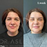 Vorher-nachher-Ergebnis Deep Plane Facelift bei Liv Hospital Ulus, sichtbare Verjüngung