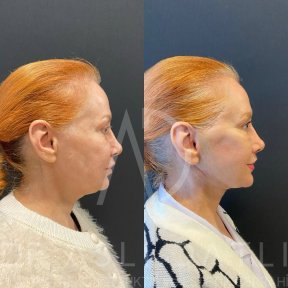 Vorher-nachher-Ergebnis Deep Plane Facelift bei Liv Hospital Ulus, sichtbare Verjüngung
