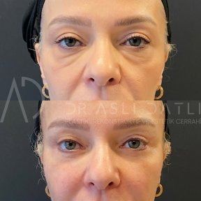 Vorher-nachher-Ergebnis Deep Plane Facelift bei Liv Hospital Ulus, sichtbare Verjüngung