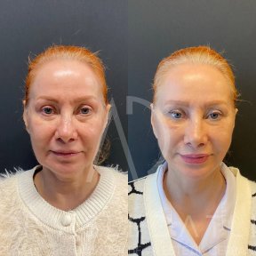 Vorher-nachher-Ergebnis Deep Plane Facelift bei Liv Hospital Ulus, sichtbare Verjüngung