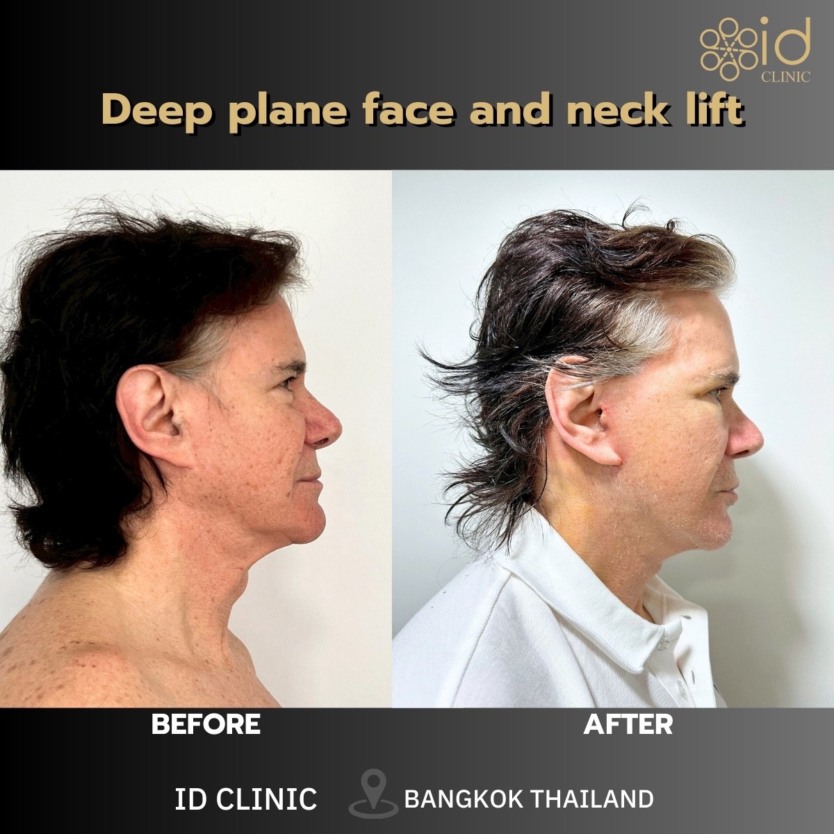 Before and after deep plane face and neck lift results at ID Clinic Bangkok, visible rejuvenation