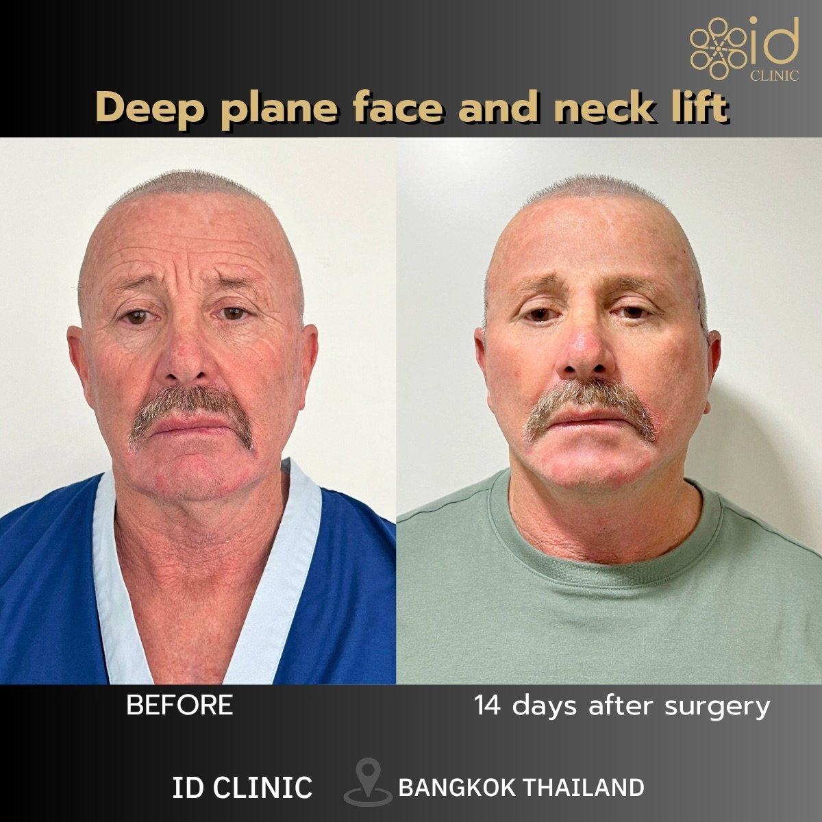 Before and after deep plane face and neck lift results at ID Clinic Bangkok, visible rejuvenation