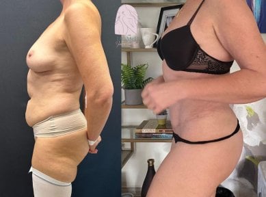 Before and after liposuction results at Dr. MED – visible abdominal contour improvement