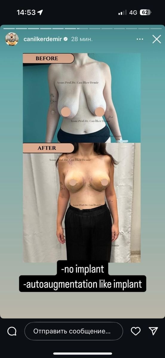 Before and after breast autoaugmentation results without implants at Memorial Bahçelievler Hospital