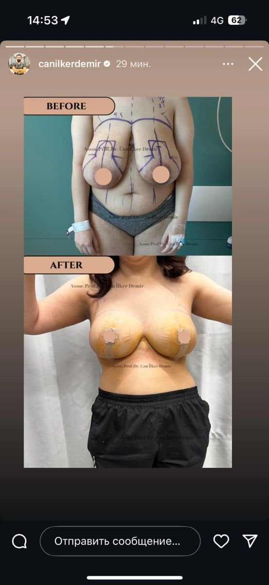 Before and after breast reduction results at Memorial Bahçelievler Hospital, improved contour