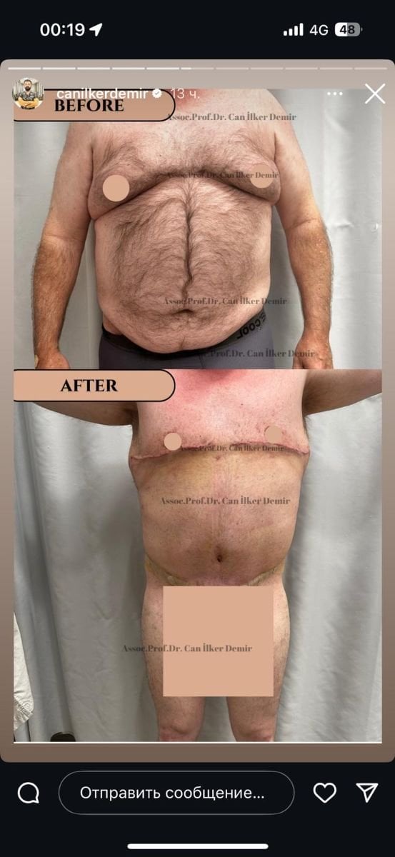 Full body lift before and after results at Memorial Bahçelievler Hospital, improved body contour