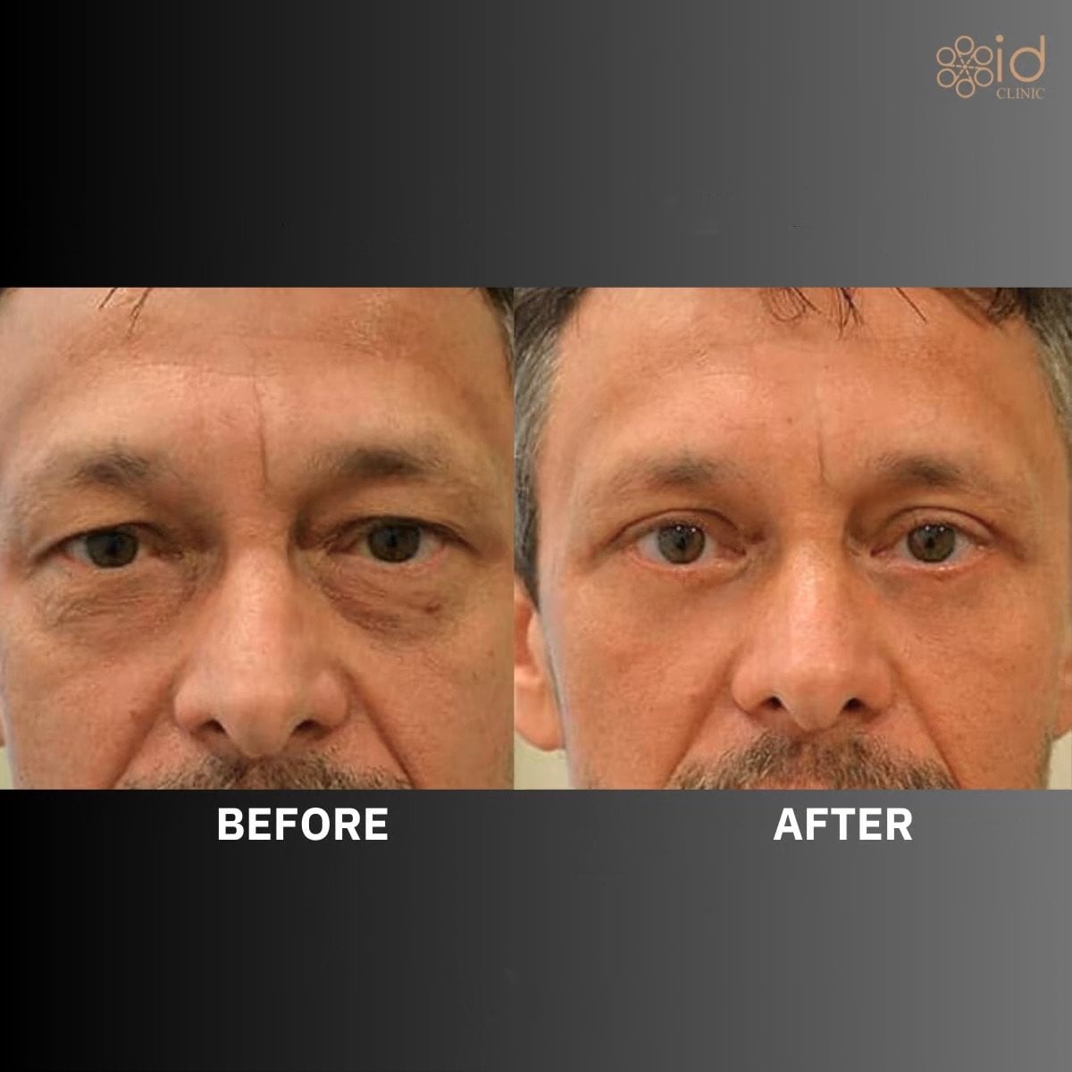 نتائج جراحة الجفن العلوي قبل وبعد في ID Clinic Bangkok، مظهر عيون متجدد
