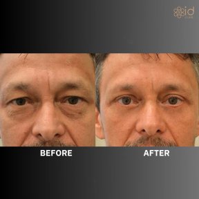 Before and after upper eyelid surgery results at ID Clinic Bangkok, rejuvenated eye appearance