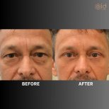 Before and after upper eyelid surgery results at ID Clinic Bangkok, rejuvenated eye appearance