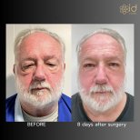 Before and after upper eyelid surgery results at ID Clinic Bangkok, reduced eyelid puffiness