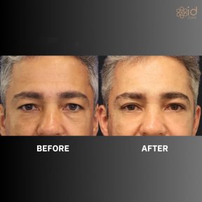 Before and after upper eyelid surgery results at ID Clinic Bangkok, rejuvenated eye appearance