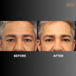 Before and after upper eyelid surgery results at ID Clinic Bangkok, rejuvenated eye appearance