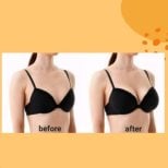 Before and after breast implants with lift results at ID Clinic Bangkok, enhanced breast shape