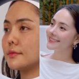 Before and after rhinoplasty result at Dr. Chen Surgery Hospital International Center, nose reshaping