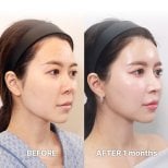 Before and after Fox Eye Lift results at Returning Plastic Surgery, lifted eye contour visible