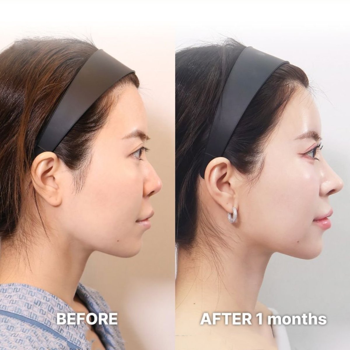 نتائج قبل وبعد Fox Eye Lift في Returning Plastic Surgery – رفع واضح لمنطقة العين