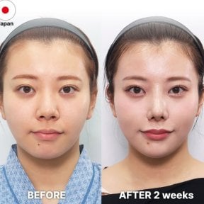Fox Eye Lift before and after results at Returning Plastic Surgery, visible eye area enhancement