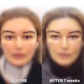 Before and after Fox Eye Lift results at Returning Plastic Surgery, visible eyelid lift effect