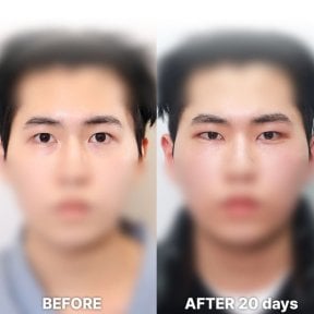 Fox Eye Lift before and after 20 days result at Returning Plastic Surgery, lifted eye contour
