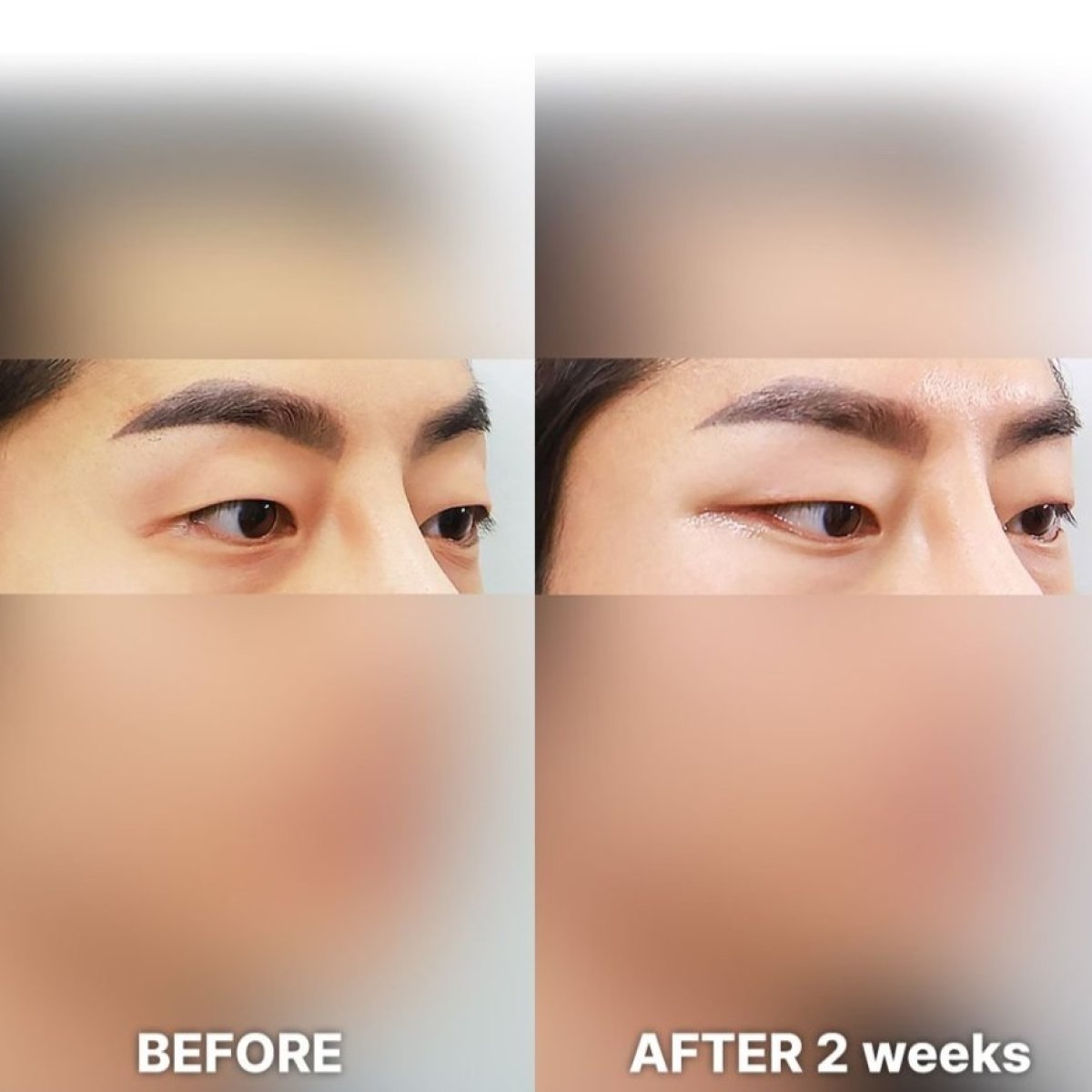 نتائج قبل وبعد Fox Eye Lift في Returning Plastic Surgery، رفع واضح لمنطقة العين