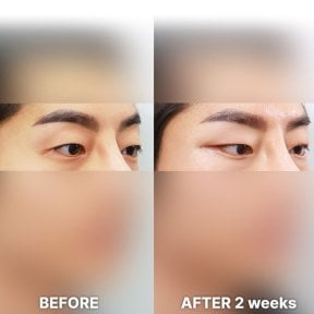 Fox Eye Lift before and after results at Returning Plastic Surgery, lifted eye contour visible