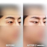 Fox Eye Lift before and after results at Returning Plastic Surgery, lifted eye contour visible