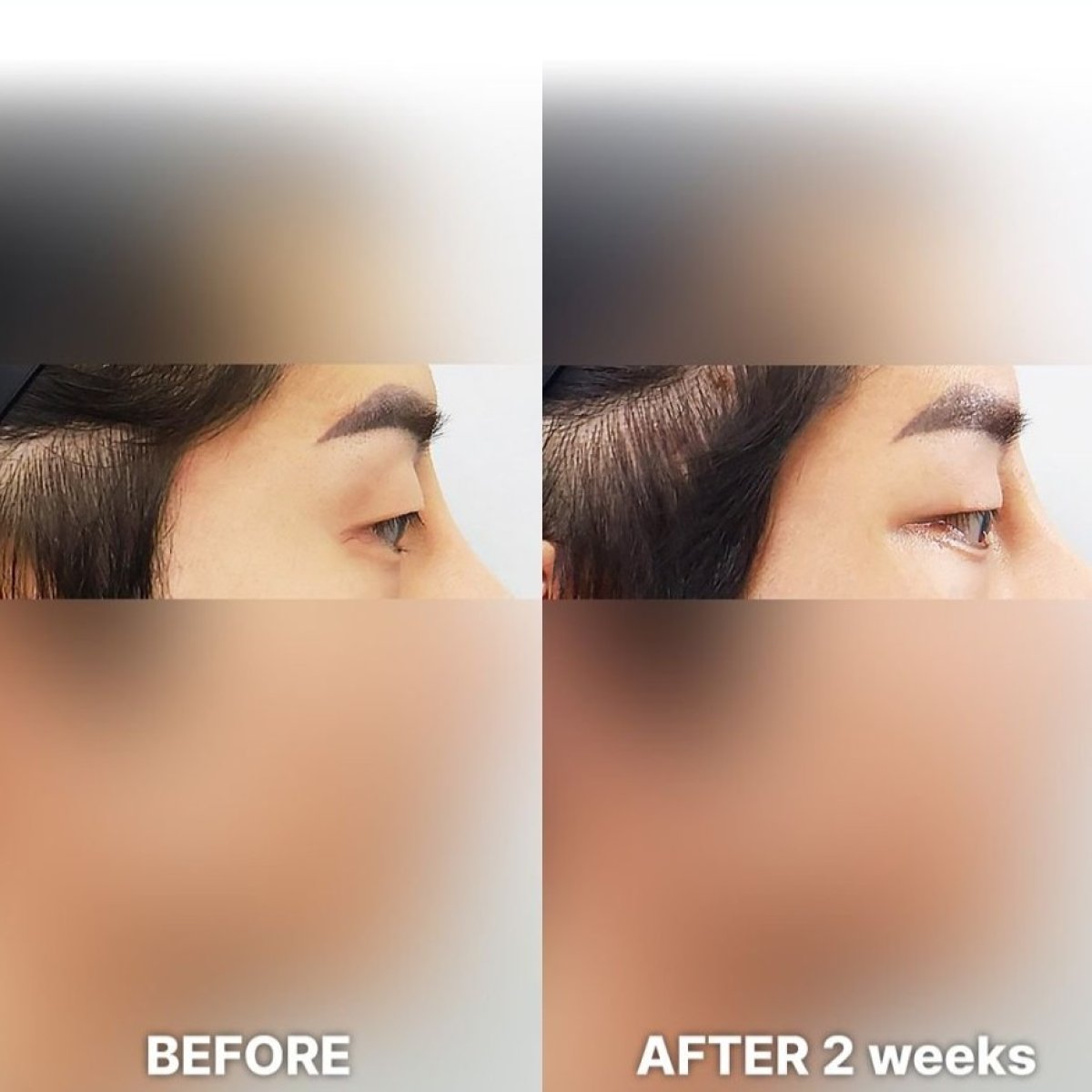 نتائج قبل وبعد Fox Eye Lift في Returning Plastic Surgery، رفع واضح للحاجب